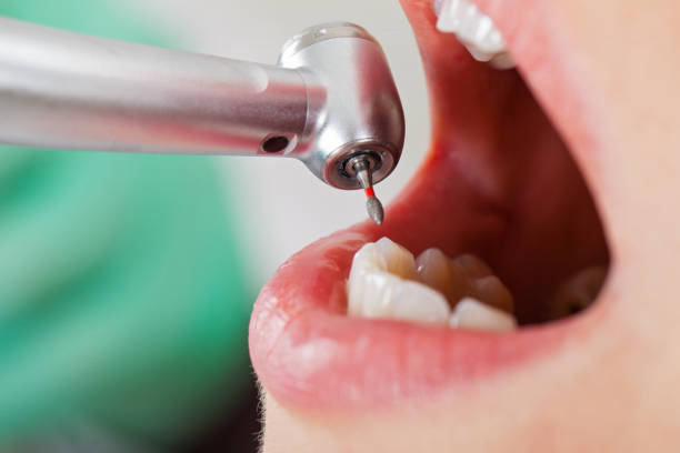 Best Emergency Root Canal Treatment in Peralta, NM